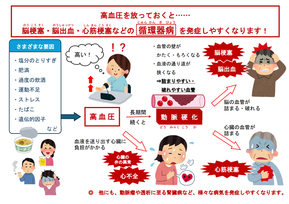 高血圧をそのままにしたときに発症率の高い病気（心筋梗塞、心不全、脳梗塞など）を文字とイラストで示したもの